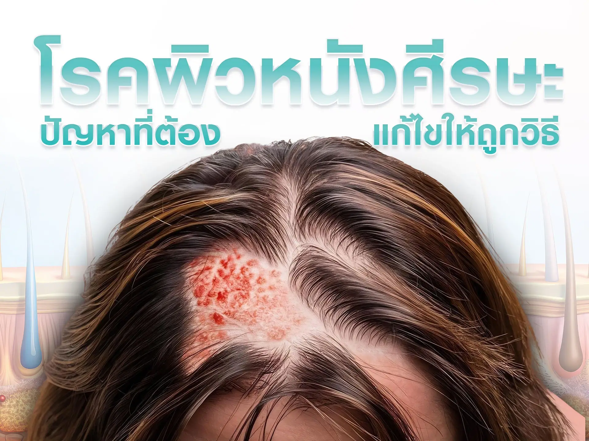 โรคผิวหนังที่หนังศีรษะ ปัญหาหนังศีรษะที่ต้องการแก้ไขให้ถูกวิธี