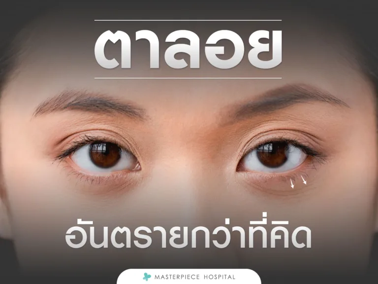 ตาลอยอาจจะอันตรายกว่าที่คิด เช็กให้ชัวร์ แก้ทัน คืนดวงตาที่สดใส