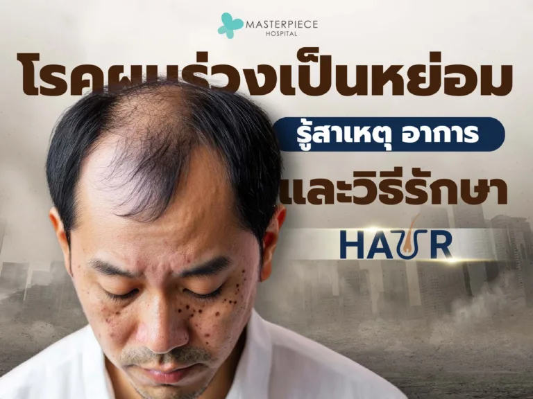 โรคผมร่วงเป็นหย่อม รู้สาเหตุ อาการ และวิธีรักษา